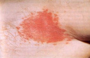 schimmelinfectie tepel symptomen