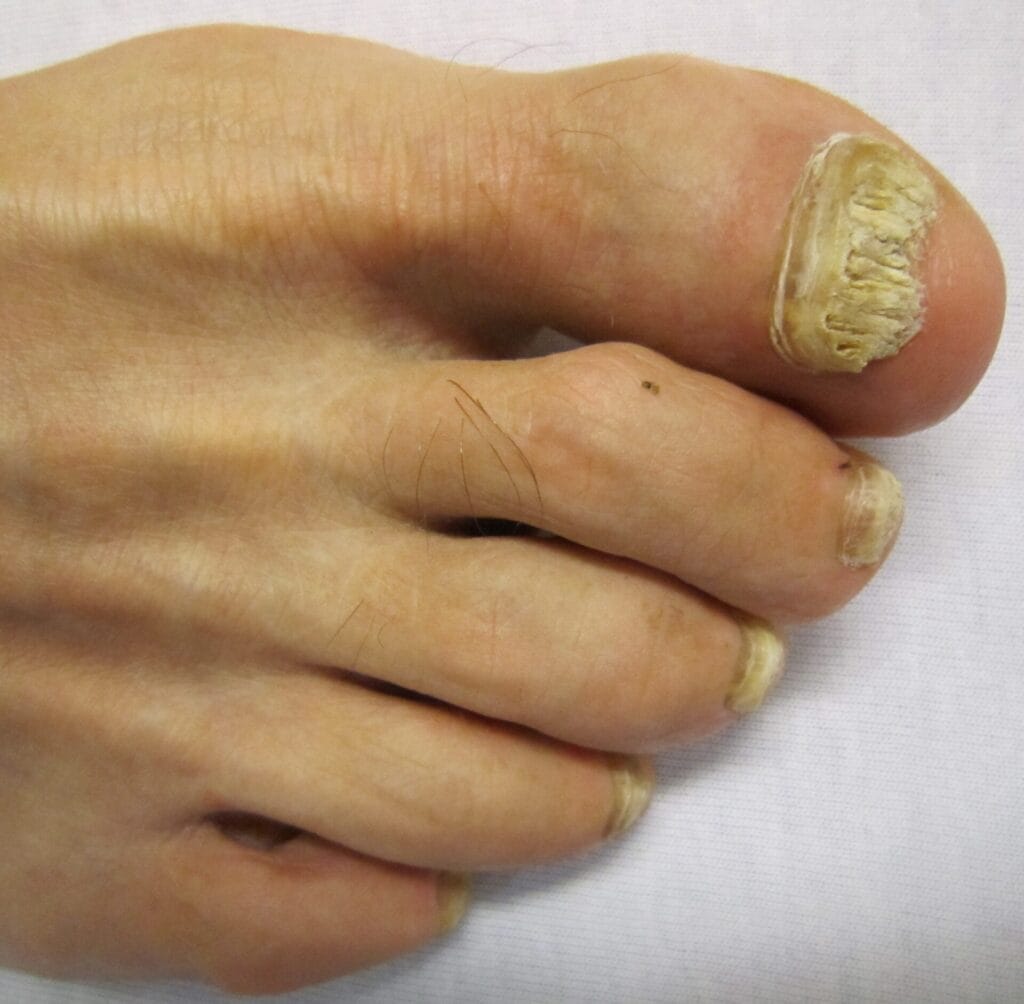 Voet met kalknagels: de nagel van de grote teen is sterk verdikt, wit-geel en brokkelig, en ook de andere teennagels zijn verdikt en verkleurd