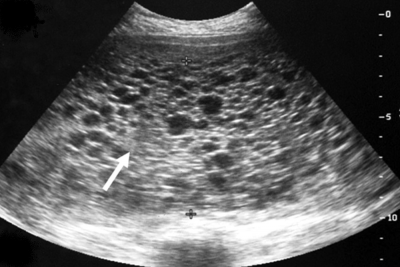Mola-zwangerschap echo