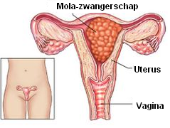 Mola-zwangerschap