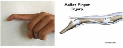 mallet-vinger
