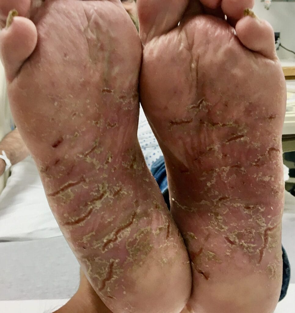 Beide voetzolen met rode, grove en korstige schilfering over de hele zool en de hiel en met diepe kloven, het mocassinpatroon bij voetschimmel