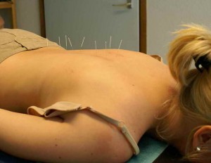 Acupunctuur Endorfinen