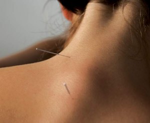Acupunctuur Meridianen