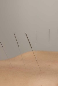 Acupunctuur Naalden