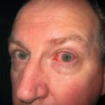 Acute conjunctivitis Acute conjunctivitis