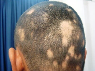 Alopecia areata