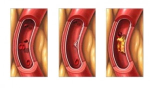 Arteriosclerose