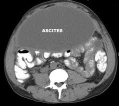 ascites buik alcohol ascites buik alcohol