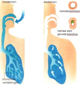 Tekening van in- en uitademen bij astma, met daarnaast een normale bronchus en een bronchus die vol zit met taai slijm