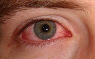 Bloed in het oog Bloed in het oog