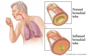 Bronchitis