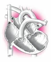 Congestieve myocardiopathie