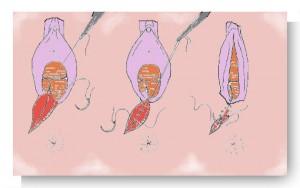 Episiotomie Veel Voorkomende Ziekten Menselijk Lichaam Menselijk Lichaam