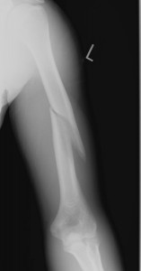Fractuur