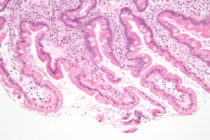 Giardiasis