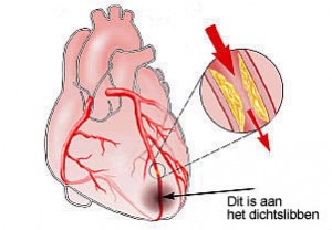 Hartinfarct