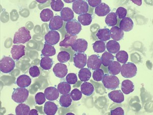 Leukemie