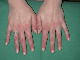 Lupus erythematodes Lupus erythematodes