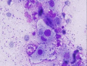 Lymphogranuloma inguinale