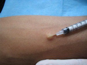 Mantoux Mantoux