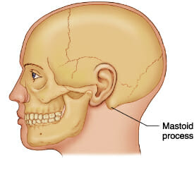 Mastoiditis Mastoiditis