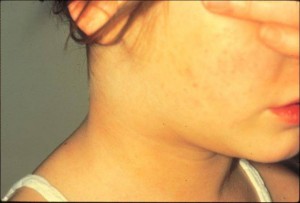 Mononucleosis
