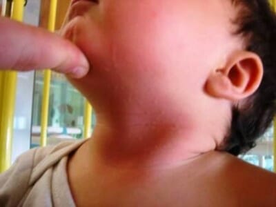Netelroos bij kinderen