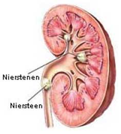 Nierstenen