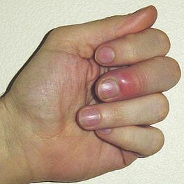 Panaritium