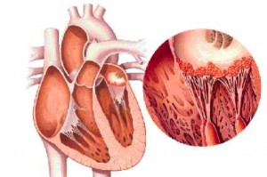 Pancarditis