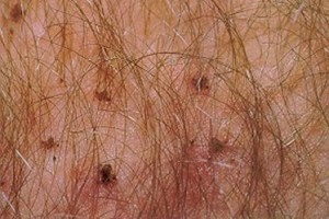 Pediculose