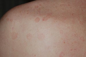 Pityriasis Pityriasis