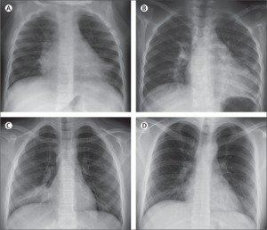 Pneumococcale pneumonie