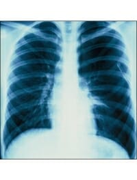 Pneumothorax Pneumothorax