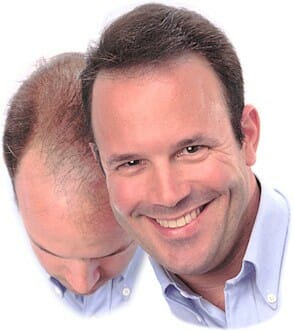 Ritme van de haargroei