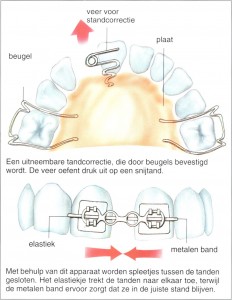 Scheefstand van tanden en kiezen