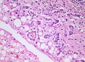 Steatose