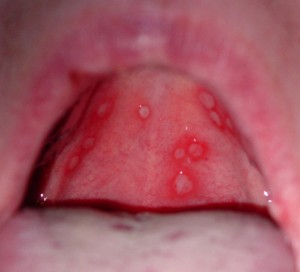 Stomatitis Stomatitis