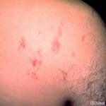 Strongyloidiasis