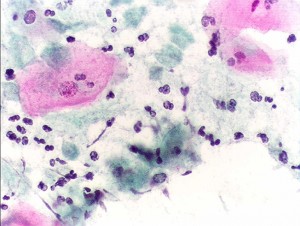 Trichomonas+ Trichomonas
