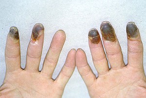 Trombangiitis obliterans Trombangiitis obliterans