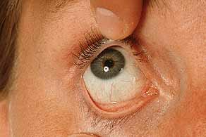 Tunica conjunctiva