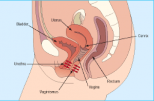 Vaginisme Vaginisme