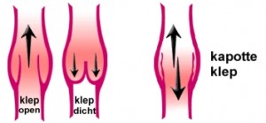 Varices Varices