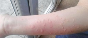 allergische reactie van warmte en kou