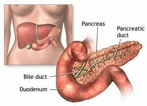oorzaak diabetes alvleesklierkanker
