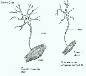 amyotrofische laterale sclerose