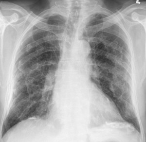 asbestosis