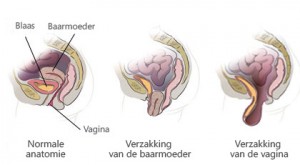 baarmoederverzakking